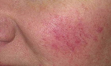 розацеа начальная стадия фото