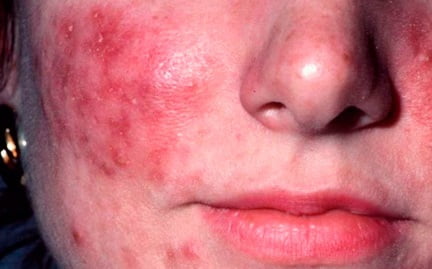 розацеа симптомы