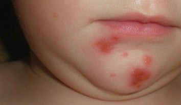 стрептодермия фото