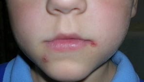 стрептодермия лечение