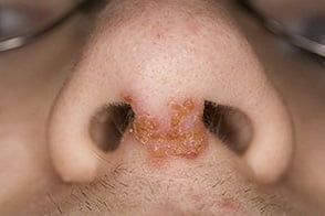 стрептодермия симптомы