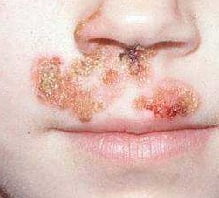 стрептодермия