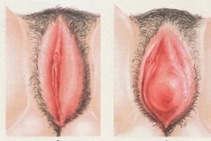 вульвит фото